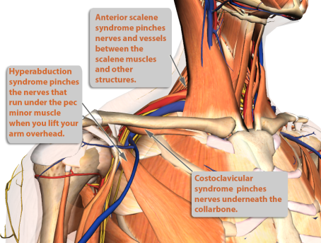 Thoracic-outlet